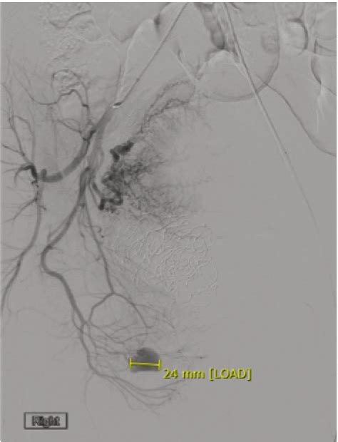 Figure 4 From A Ruptured Vulvar Labial Artery Pseudoaneurysm Causes A