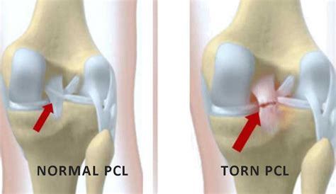 PCL Surgery