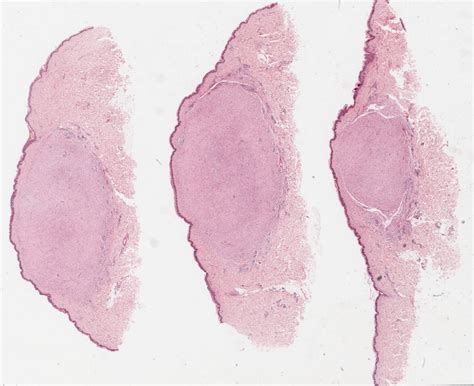 Neurofibroma Histology