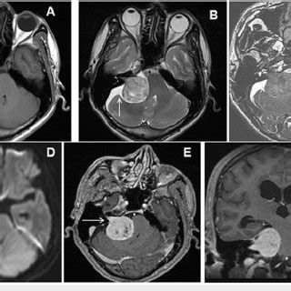 Cranial MRI Of A 50 Year Old Male Patient With Vertigo And Ataxia Due