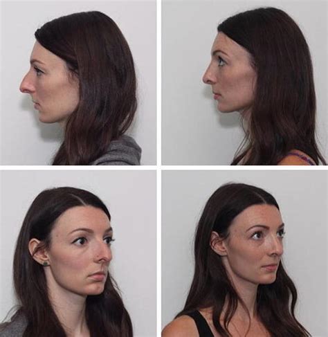 Deviated Septum Before And After (15) » Rhinoplasty: Cost, Pics, Reviews, Q&A