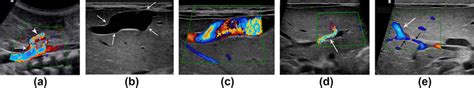 Gray Scale And Color Doppler Us On Day 1 Of Life Showing A