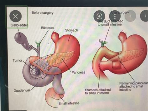 Pancreatic Cancer Flashcards Quizlet