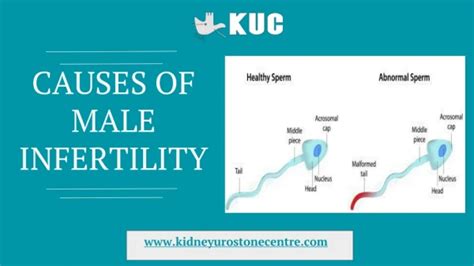 PPT Male Infertility Causes And Treatment PowerPoint Presentation