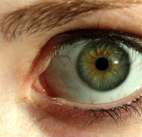 Why Do Some People Have Dark Rings Around The Iris Of Their Eye Hubpages