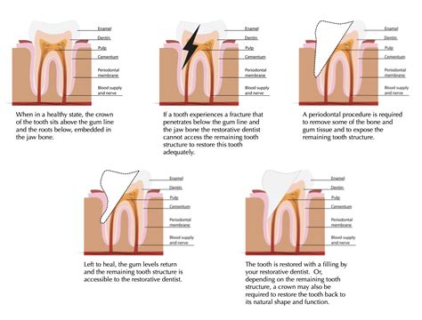 Conventional Crown Lengthening 101 - Dr. Peter Fritz