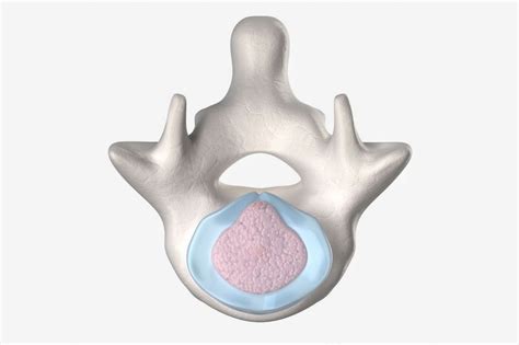 Annular Fissure: Spinal Pain of Intervertebral Discs