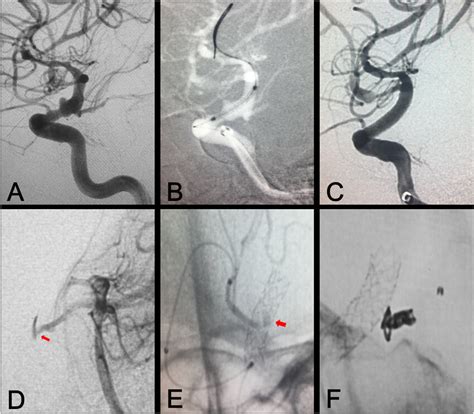 Embolization Of Branch Artery For Type Ii Endoleak A Pre Procedural