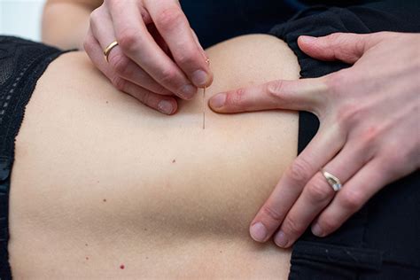 Myofasciale Therapie Dry Needling Kin Kaatje Roef