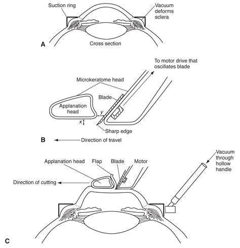 Microkeratome American Academy Of Ophthalmology