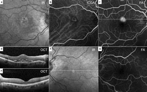 Multimodal Imaging Of Type 2 MNV Without Deposits A Central