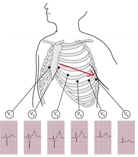 Precordial Leads In Electrocardiography V1 V2 V3 V4 V5 59 Off