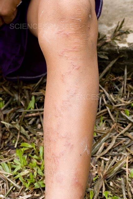 Cutaneous Larva Migrans Stock Image Science Source Images