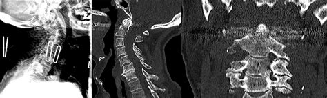 Preoperative Lateral Plain Cervical Radiograph Left Mid Sagittal