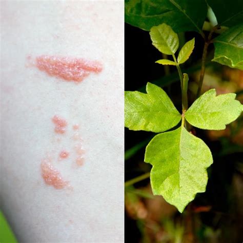 List 90 Pictures Photos Of Poison Oak Rash Superb