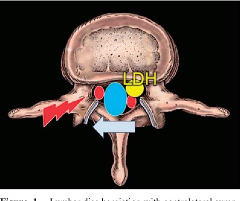 Figure From Radiculopathy Contralateral To The Side Of Disc