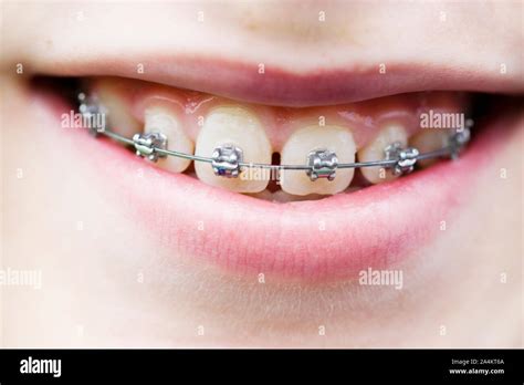 Boy With Braces Stock Photo Alamy