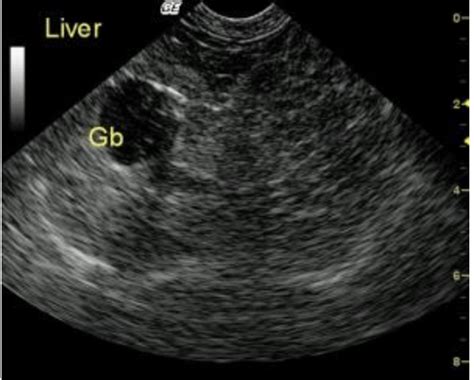 Hepatocutaneous Syndrome With Crusting Skin Lesions In A 9 Year Old Fs