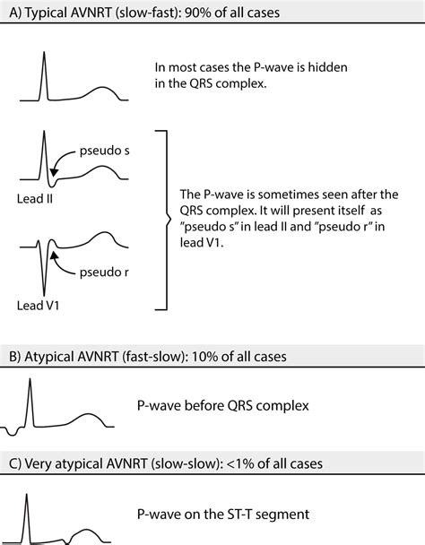 Figure 2. Types of AVNRT. – ECG learning