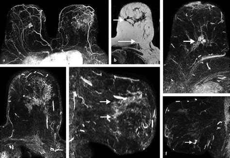 Diagnostic Mri Breast Cancer Applications Radiology Key