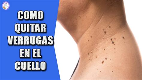 Como Quitar Verrugas En El Cuello Youtube