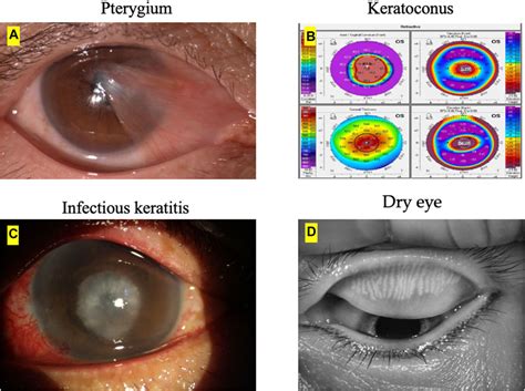 Frontiers Artificial Intelligence Assisted Diagnosis Of Ocular