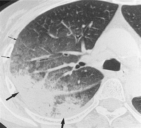 High resolution computed tomography of chronic eosinophilic pneumonia ...