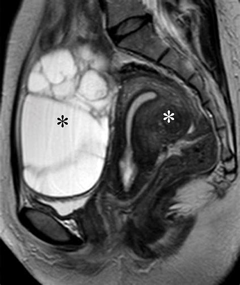 Mucinous Neoplasms Of The Ovary Radiologic Pathologic Correlation Radiographics