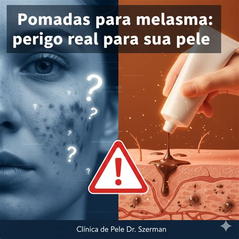 Qual A Melhor Pomada Para Melasma - Pomadas Para Melasma: Perigo Real Para Sua Pele - O Melhor Tratamento ...