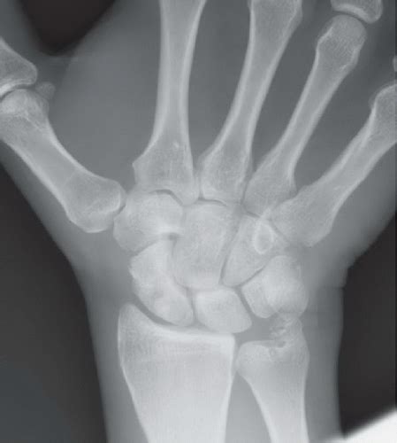 Scaphoid Fracture Radiology Key