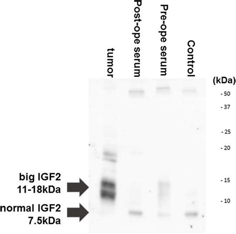 Western Immunoblot Analysis Of Serum And Tumor Insulin Growth Factor 2