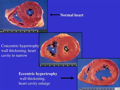 Ppt Hypertension Powerpoint Presentation Free Download Id5084182