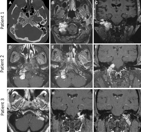 Advances in Head and Neck Paraganglioma Imaging - Advances in Clinical ...