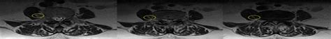 Female Sex And Supine Proximal Lumbar Lordosis Are Associate Spine