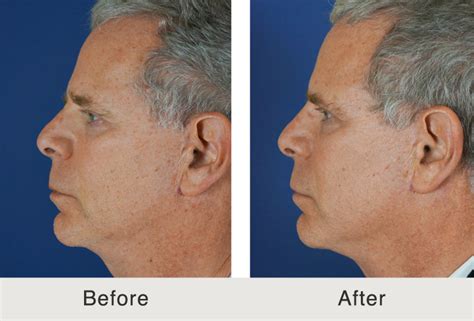 Before After Male Filler Temples Tear Trough Cheeks And Lips