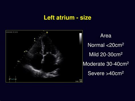 Ppt Basic Echocardiography Powerpoint Presentation Free Download