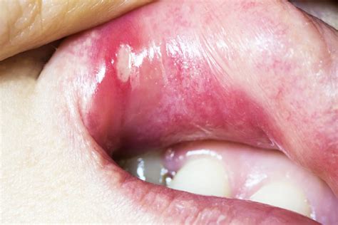 Mouth Ulcers: Causes, Symptoms and Treatment — Healthy Builderz