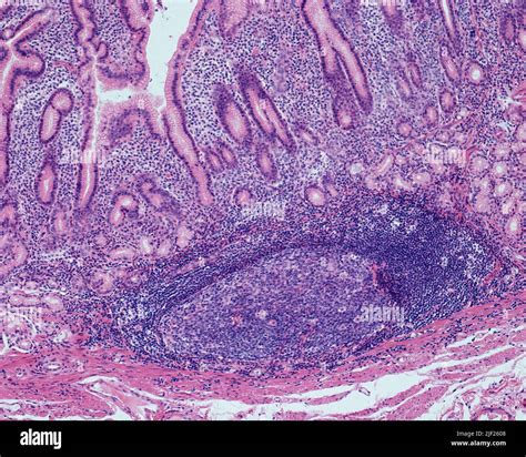 Chronic Gastritis Light Micrograph Of Human Antral Gastric Mucosa Showing Extensive Chronic