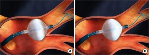 Cryoballoon Ablation For Atrial Fibrillation A Comprehensive Review And Practice Guide