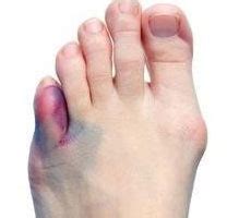 Heel Spur Treatment: Symptoms of Bone spurs