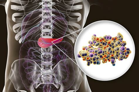 Insulinoma Causas S Ntomas Y Tratamientos Mejor Con Salud