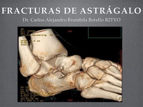 Fracturas Del Astragalo