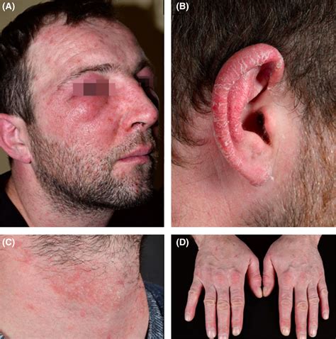 Contact allergy to methylisothiazolinone with three clinical