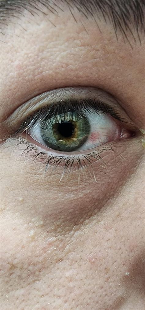 Red spot in my eye white area? : r/medical