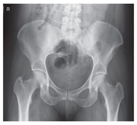 Chapter 7 Femur And Pelvic Girdle Flashcards Quizlet