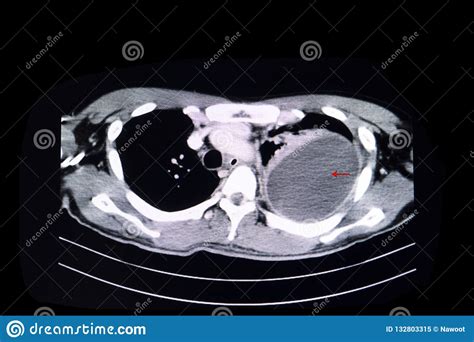 Loculated pleural effusion stock image. Image of hospital - 132803315