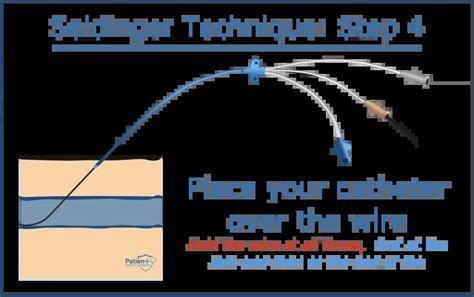 The Seldinger Technique A Comprehensive Guide Patient Safety Experts