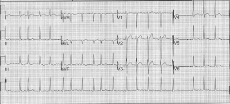 The initial 12-Lead EKG of the 29-year-old male before treatment ...