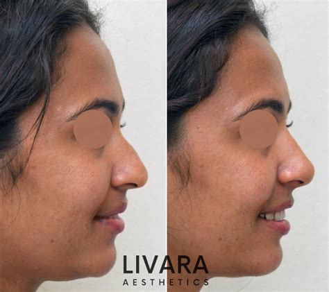 Non Surgical Rhinoplasty Pros Cons Of Nose Filler Treatments