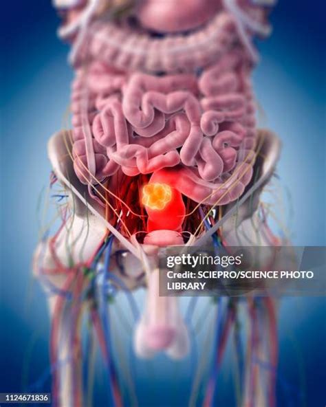 Rectal Cancer Photos And Premium High Res Pictures Getty Images